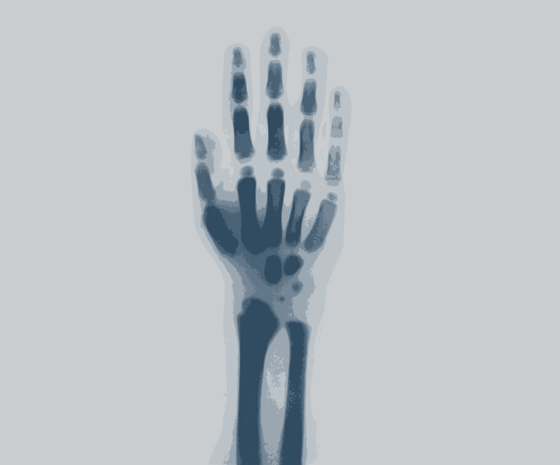 X-ray of a Hand